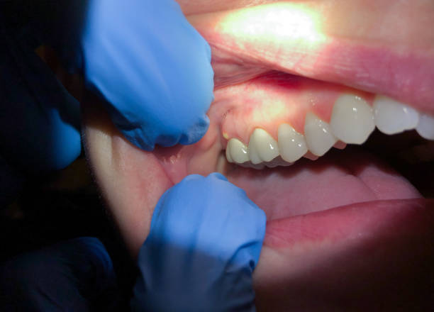 Best Emergency Root Canal Treatment in Linn, MO
