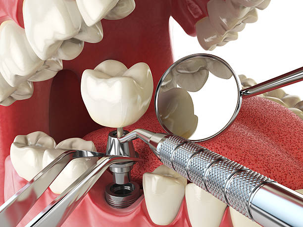 Best Emergency Wisdom Teeth Removal in Linn, MO